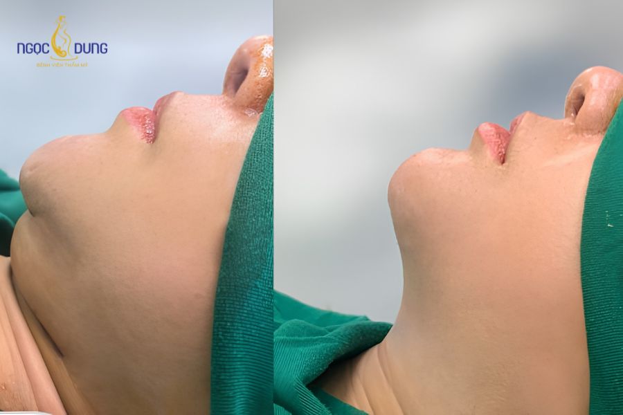 Điêu khắc đường line mặt: Sở hữu gương mặt V-Line đẹp 11 Phẫu thuật gọt xương hàm điều chỉnh góc hàm bạnh vuông