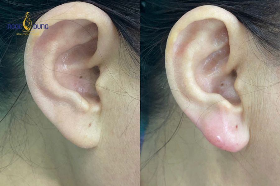 Chỉnh hình dái tai: Phương pháp, quy trình và bảng giá 9 Phẫu thuật tiểu phẫu cắt và khâu thẩm mỹ phục hồi dái tai