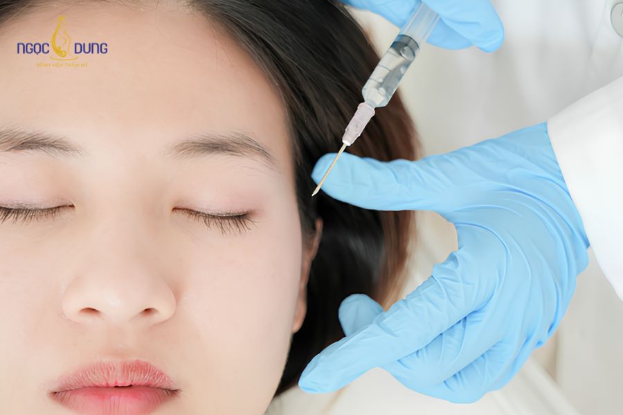 Độn thái dương là gì? Các phương pháp và bảng giá 2026 12 Quy trình độn thái dương chuẩn y khoa tại Bệnh viện Thẩm mỹ Ngọc Dung