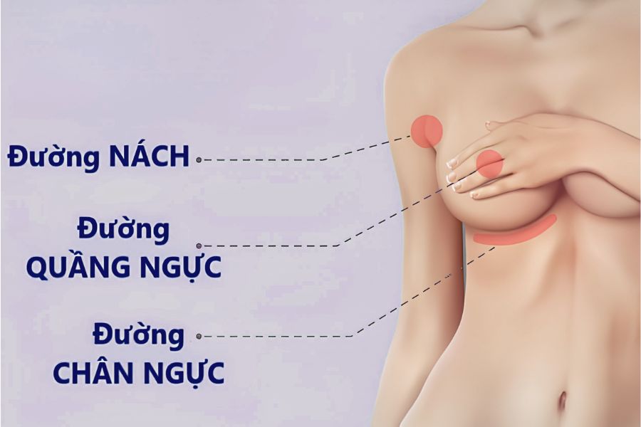 Nâng ngực nội soi túi Nano: Bảng giá, quy trình chuẩn 20 Sơ đồ minh họa ba đường tiếp cận đặt túi ngực nội soi y khoa