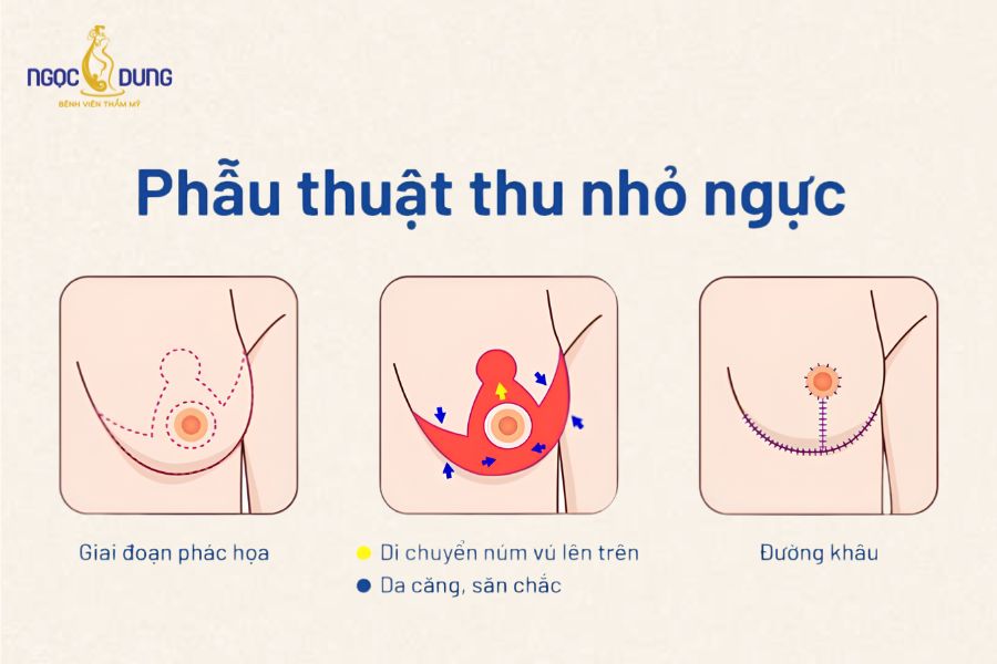 Phẫu thuật thu nhỏ ngực: Bảng giá, quy trình và lưu ý 18 Sơ đồ minh họa các đường mổ thu nhỏ ngực