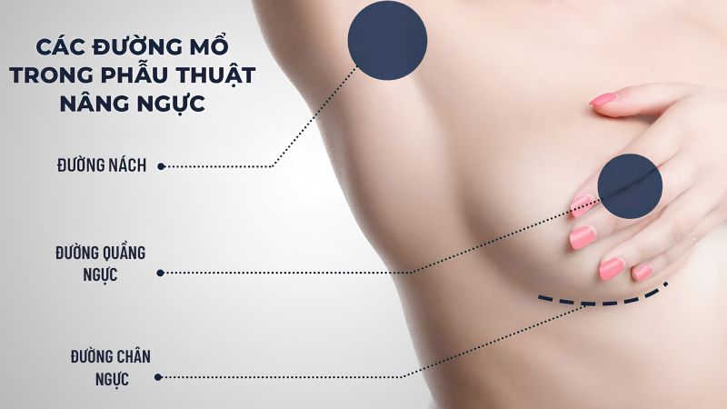 Phẫu thuật nâng ngực: Bảng giá, phương pháp và quy trình 10 Sơ đồ minh họa đường mổ phổ biến trong phẫu thuật đặt túi ngực