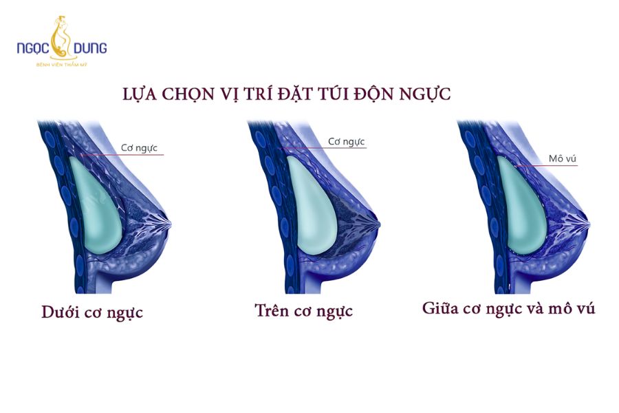Tổng hợp các loại túi nâng ngực phổ biến và cách chọn 13 Sơ đồ minh họa vị trí đặt túi ngực dưới cơ hoặc dưới tuyến vú