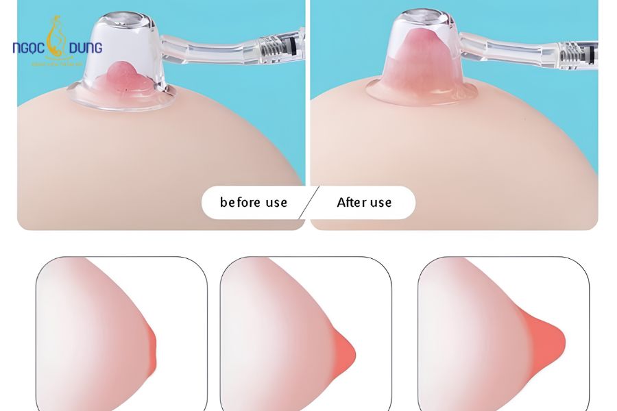 Phẫu thuật kéo núm vú tụt: Bảng giá, quy trình 2026 12 Sử dụng dụng cụ hỗ trợ kéo đầu ti nhô ra tại nhà