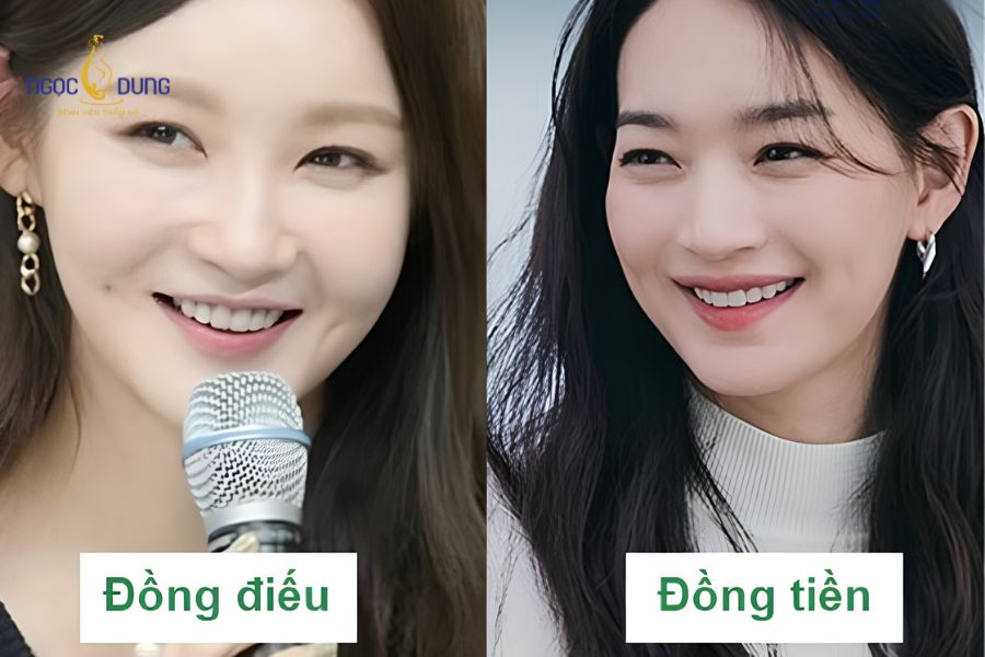 Cắt đồng điếu là gì? Chi phí, quy trình và ý nghĩa nhân tướng học 8 Sự khác biệt trực quan về vị trí giữa đồng điếu và má lúm đồng tiền