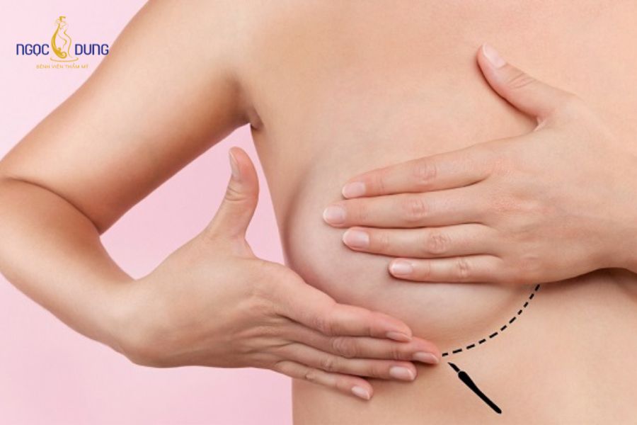 Nâng ngực bao lâu được đi xe máy? Cảnh báo và hướng dẫn 11 Sự va chạm hoặc phanh gấp khi lái xe dễ làm tác động tiêu cực đến đường khâu vết mổ