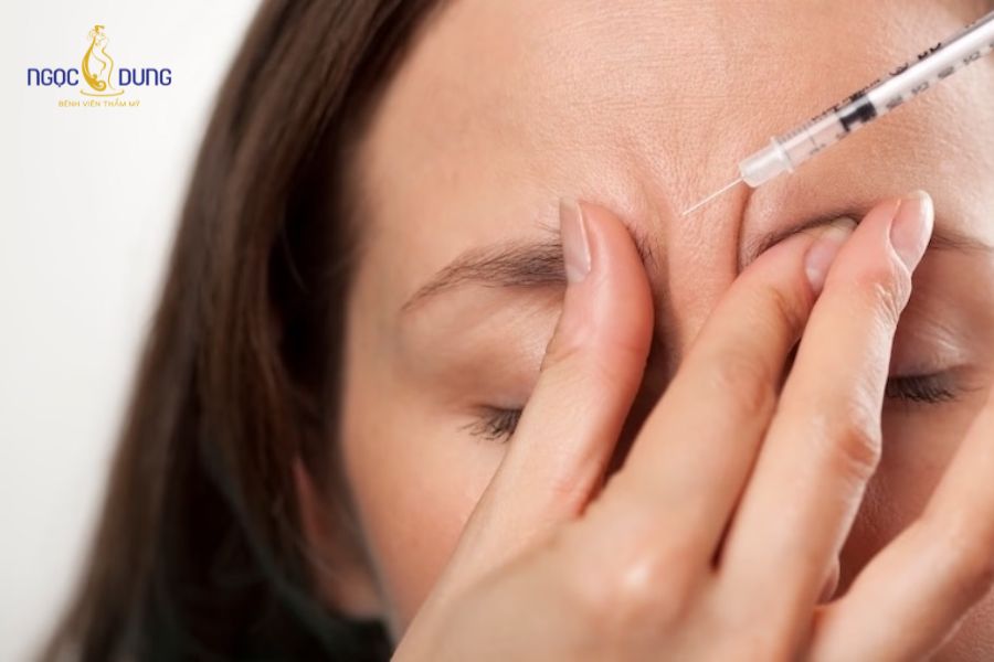 10 cách giảm nhăn cơ cau mày an toàn, lấy lại thanh xuân 8 Tiêm Botox xóa nhăn cơ cau mày là lựa chọn phổ biến