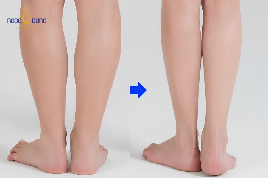 Hút mỡ bắp chân: Giải pháp gọn an toàn tại Ngọc Dung 15 Tình trạng bắp chân tích mỡ dày che khuất đường nét mắt cá chân