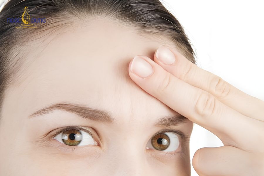 Cấy mỡ hõm trán là gì? Bảng giá và quy trình an toàn 10 Tình trạng khuyết lõm xương trán bẩm sinh tạo cảm giác gương mặt thô cứng