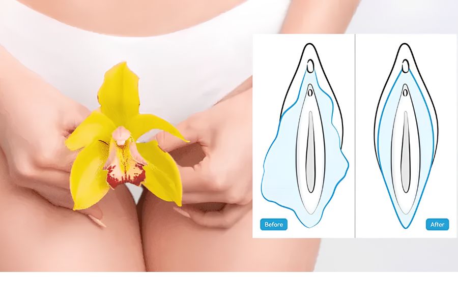 Thu gọn môi bé: Lợi ích, quy trình và lưu ý cần biết 14 Tình trạng môi bé phì đại bẩm sinh hoặc chảy xệ sau sinh nở