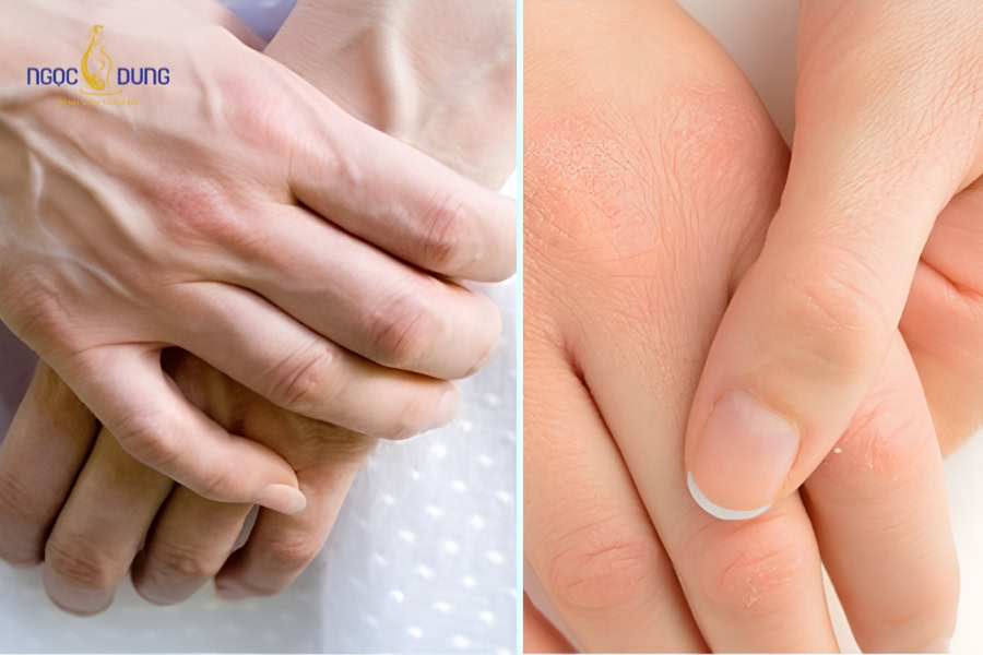 Cấy mỡ bàn tay: Trẻ hóa đôi tay tự nhiên an toàn uy tín 12 Tình trạng mu bàn tay gầy guộc, xương xẩu bẩm sinh hoặc do lão hóa