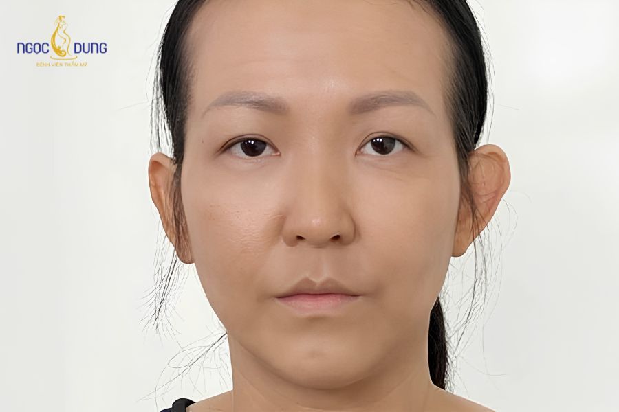 Độn thái dương là gì? Các phương pháp và bảng giá 2026 8 Tình trạng thái dương hóp sâu do lão hóa và cấu trúc xương bẩm sinh