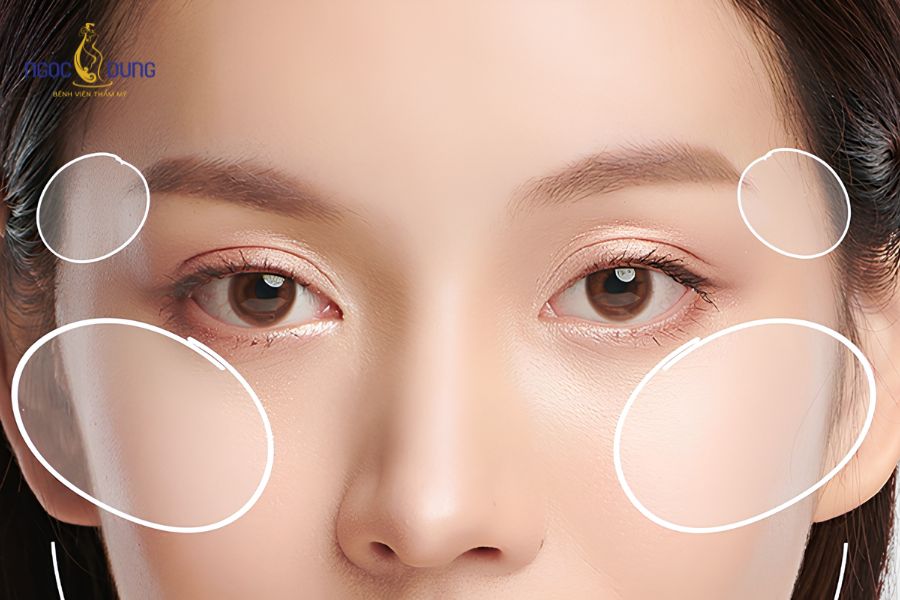 Cấy mỡ mặt vùng lẻ an toàn: Bảng giá và quy trình mới 13 Tình trạng thái dương lõm sâu bẩm sinh tạo cảm giác gương mặt hốc hác