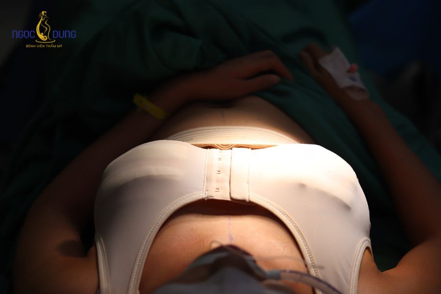 Nâng ngực bao lâu thì hết sưng? Cách chăm sóc ngực mềm 13 Trong 24 - 72 giờ đầu, ngực xuất hiện tình trạng căng tức do phản ứng viêm tự nhiên