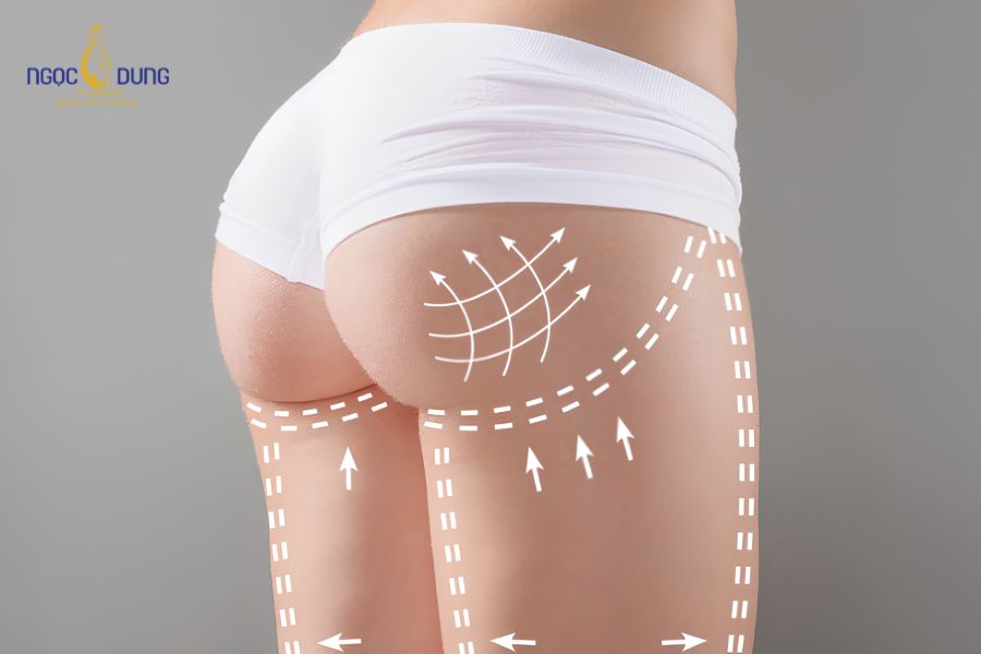 Nâng mông: Phương pháp phổ biến, bảng giá và an toàn 17 Tỷ lệ vóc dáng cân đối sau khi tạo hình vòng 3
