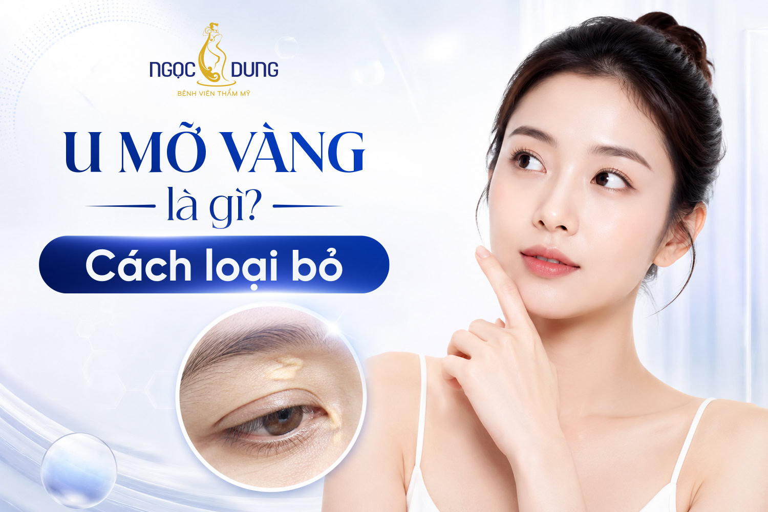 U mỡ vàng