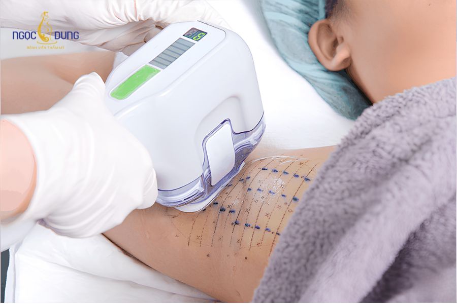 Điều trị tuyến mồ hôi: Phương pháp an toàn, dứt điểm 8 Ứng dụng năng lượng vi sóng phá hủy tuyến mồ hôi ở lớp trung bì da