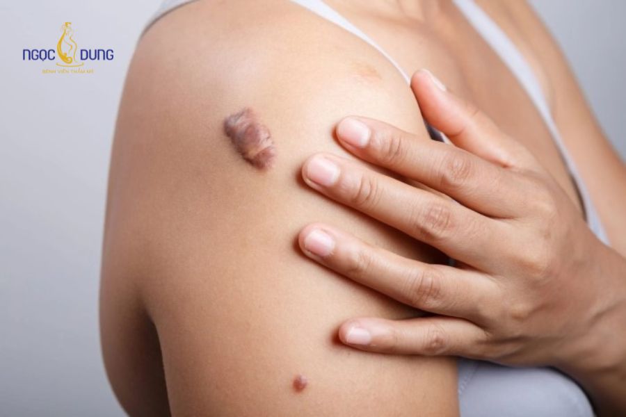 Phẫu thuật cắt sửa sẹo xấu: Các phương pháp và Quy trình 12 Ứng dụng vi phẫu trong cắt bỏ sẹo xấu giúp loại bỏ các vết sẹo lồi, sẹo lớn
