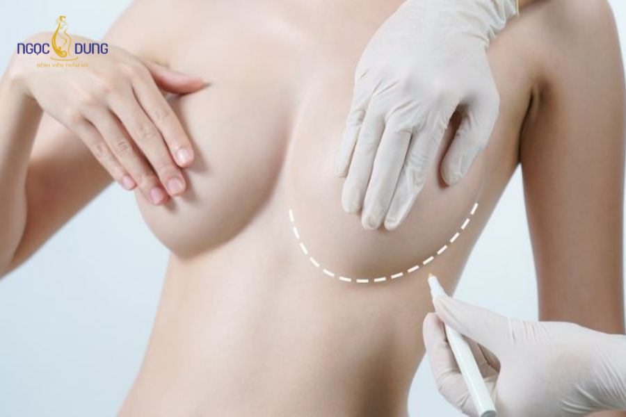 Nâng ngực bao lâu thì mềm? Chăm sóc vòng 1 tự nhiên 14 Vị trí đặt túi dưới cơ ngực mang lại phom dáng tự nhiên và bền vững lâu dài