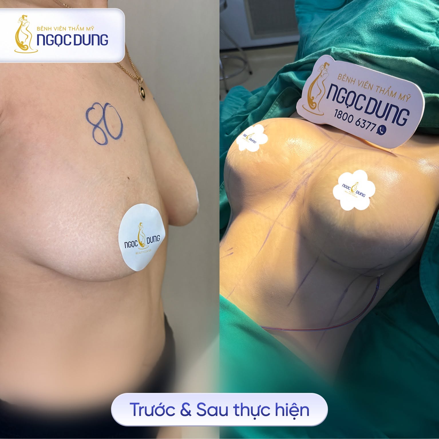 Nâng ngực nội soi túi Ergonomic chuẩn y khoa, Ngọc Dung 13 Việc lựa chọn cơ sở có đầy đủ giấy phép và đội ngũ chuyên môn rõ ràng là yếu tố quan trọng