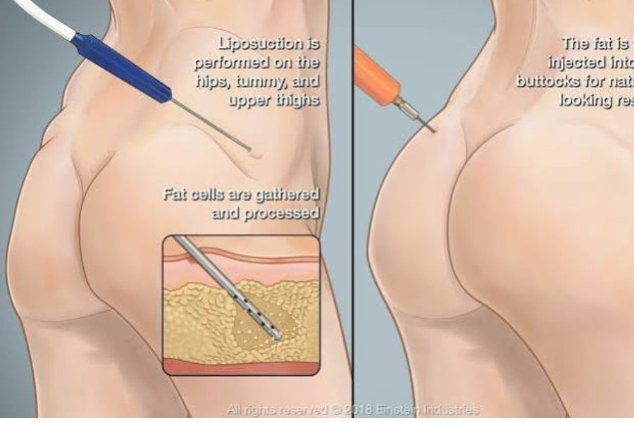 Cấy mỡ mông là gì? Có an toàn không? Bảng giá mới nhất 10 word image 12992 1