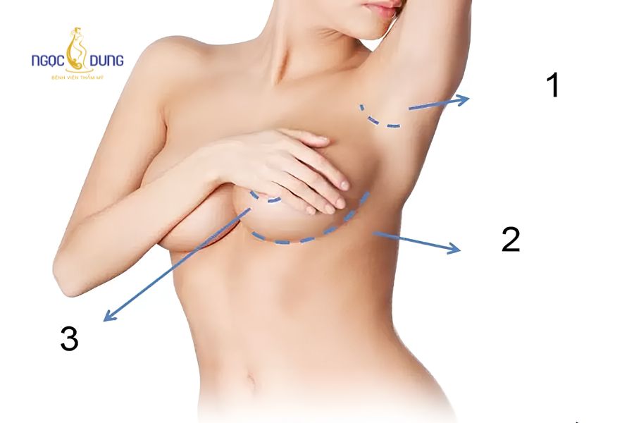 Nâng ngực đường chân ngực: Ưu nhược điểm và bảng giá 13 Ba đường mổ nâng ngực phổ biến: đường chân ngực, đường nách và đường quầng vú