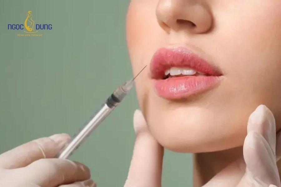 Tiêm filler rãnh cười bao nhiêu cc? Bảng giá chi tiết 21 Bác sĩ chỉ định tiêm enzym Hyaluronidase để hòa tan chất làm đầy khi cần điều chỉnh
