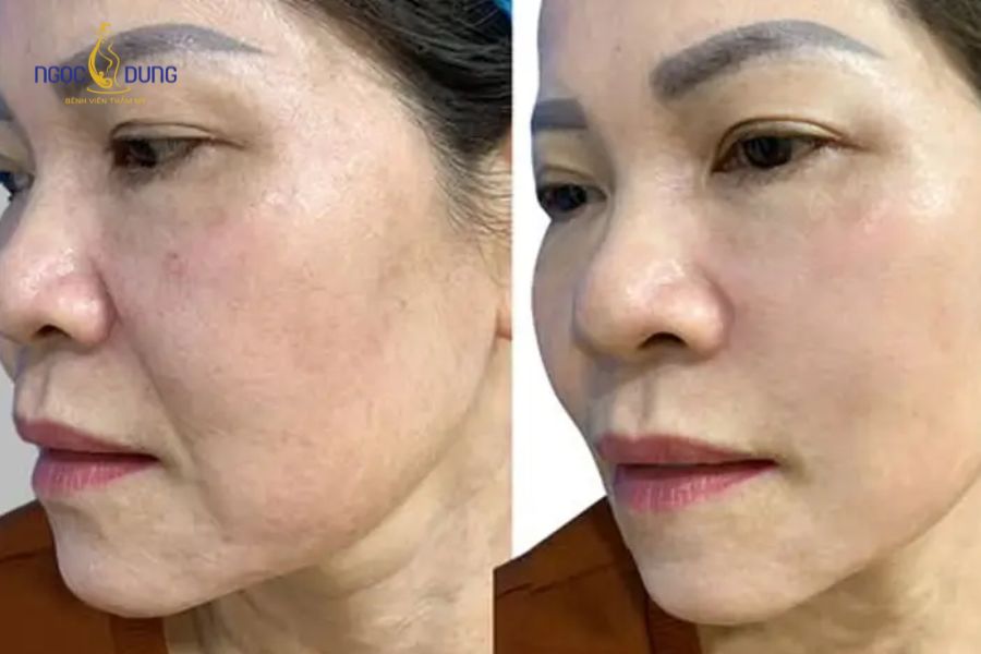Biến chứng tiêm filler: Dấu hiệu và cách xử trí chuẩn 15 Bác sĩ chuyên khoa thăm khám trực tiếp để xác định chính xác nguyên nhân và mức độ tổn thương