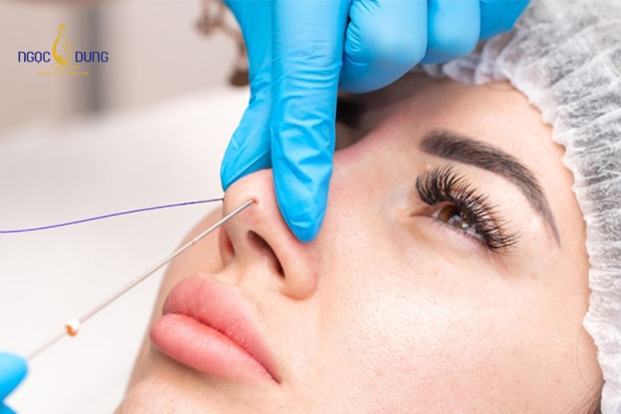 Nên nâng mũi bằng chỉ hay tiêm filler? Lựa chọn nào tốt 9 Bác sĩ sử dụng kim chuyên dụng/Cannula đưa chất làm đầy gốc Axit Hyaluronic vào vùng mũi để tạo khối
