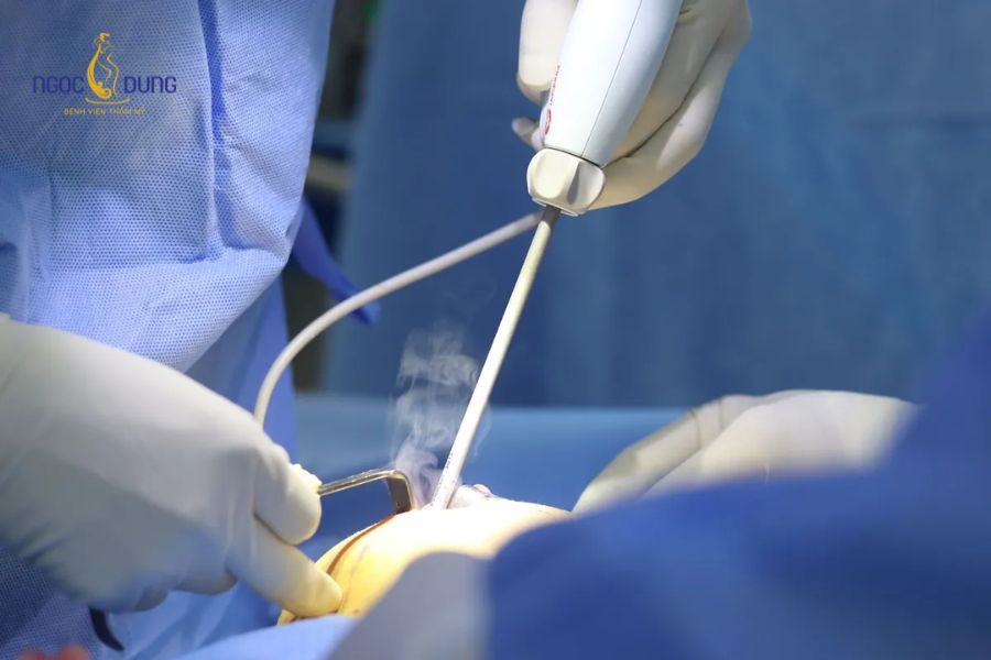 Nâng ngực bị lệch: Dấu hiệu, nguyên nhân và cách khắc phục 17 Bác sĩ tiến hành bóc tách bao xơ và thay túi độn mới để phục hồi phom dáng ngực