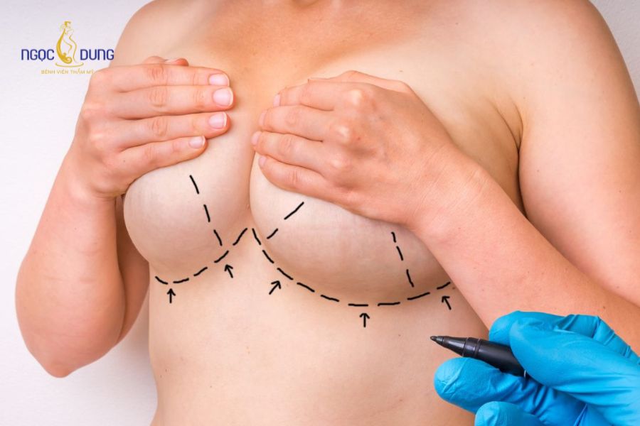 Nâng ngực có bóp được không? Bao lâu thì mềm tự nhiên? 10 Bầu ngực mềm mại, cân đối và phục hồi độ đàn hồi tự nhiên sau từ 3-6 tháng