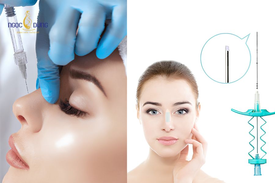 Nên nâng mũi bằng chỉ hay tiêm filler? Lựa chọn nào tốt 8 Cả hai phương pháp nâng mũi bằng chỉ và tiêm filler đều là giải pháp thẩm mỹ nội khoa không cần nghỉ dưỡng dài