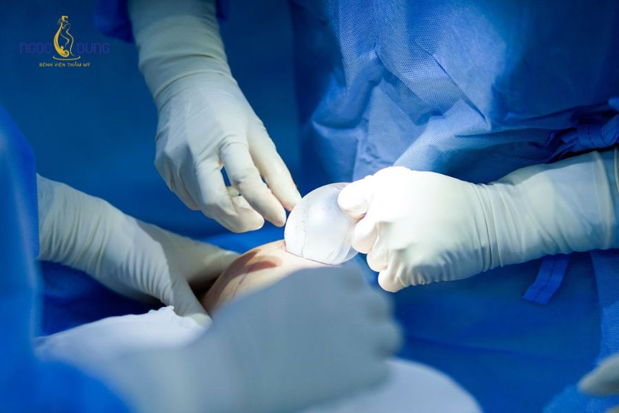 Nâng ngực đường chân ngực: Ưu nhược điểm và bảng giá 15 Ca phẫu thuật diễn ra tại phòng mổ vô trùng áp lực dương đạt chuẩn Bộ Y tế