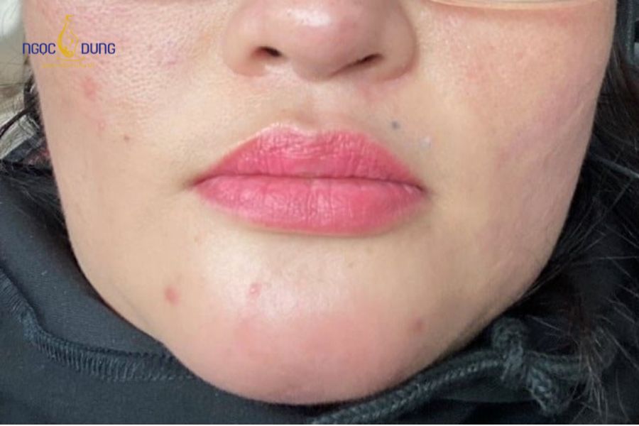 Biến chứng tiêm filler: Dấu hiệu và cách xử trí chuẩn 10 Các biến chứng sau tiêm filler có thể gây nguy hiểm nếu không xử lý kịp thời
