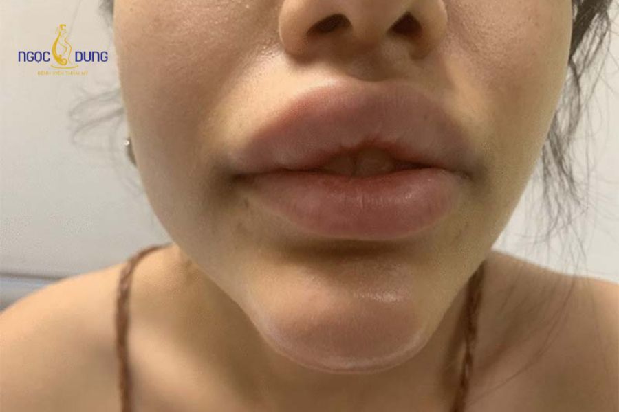 Tiêm filler cằm bị sưng đau: Nguyên nhân và cách xử lý 11 Cần đến gặp bác sĩ chuyên khoa ngay khi nhận thấy các biểu hiện sưng to, tím tái hoặc chảy dịch mủ