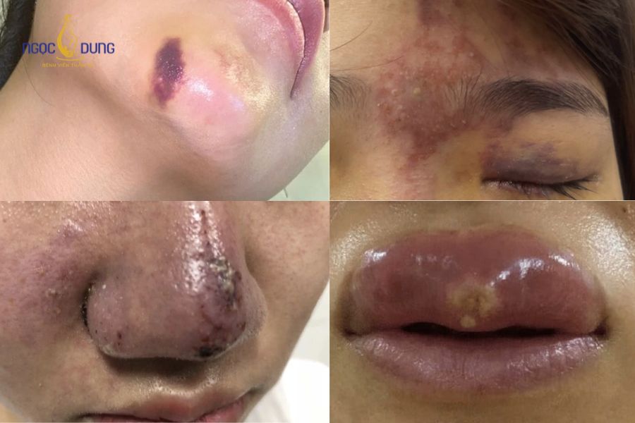 Biến chứng tiêm filler: Dấu hiệu và cách xử trí chuẩn 12 Cần thăm khám bác sĩ nếu có các dấu hiệu biến chứng tiêm filler