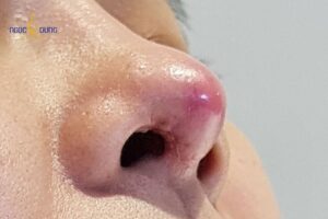 Cần thăm khám y khoa ngay khi nhận thấy vùng mũi đổi màu bầm tím, mưng mủ hoặc đau rát dồn dập