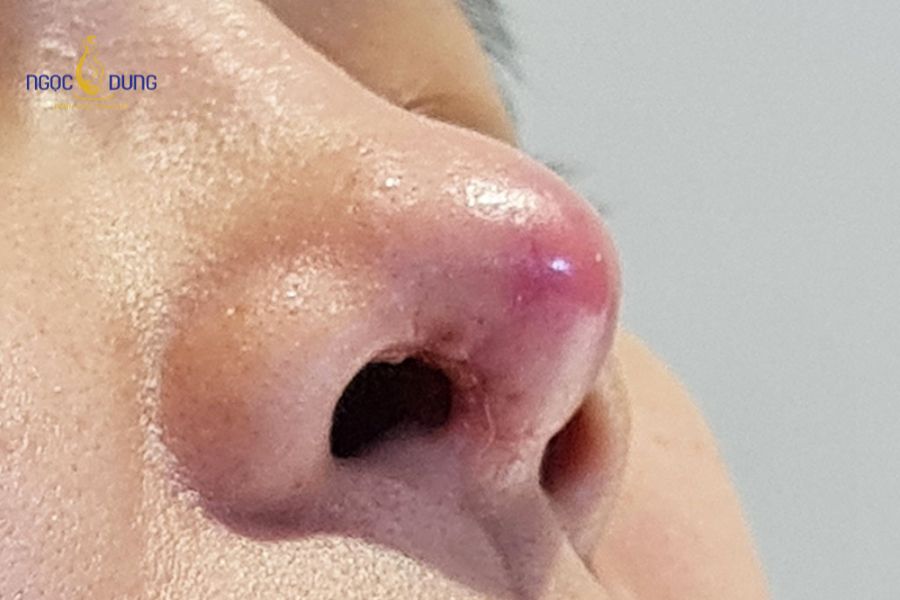 Tiêm filler mũi bị sưng: Bao lâu hết và cách giảm sưng 13 Cần thăm khám y khoa ngay khi nhận thấy vùng mũi đổi màu bầm tím, mưng mủ hoặc đau rát dồn dập