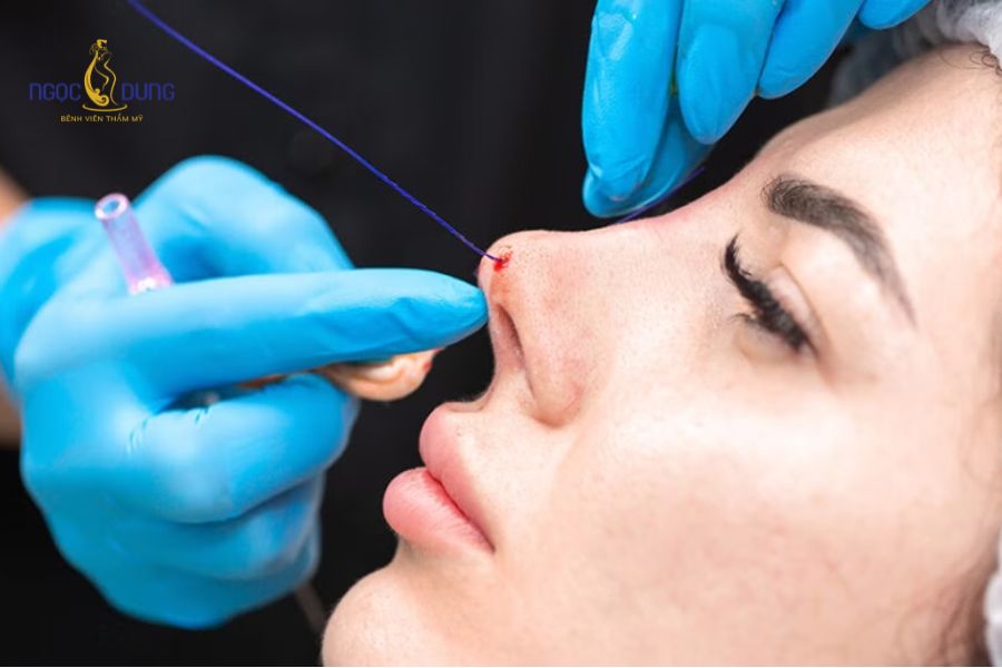 Nên nâng mũi bằng chỉ hay tiêm filler? Lựa chọn nào tốt 10 Cấy chỉ sinh học tạo hệ thống nâng đỡ mô cơ vùng mũi, kích thích tăng sinh collagen tự nhiên