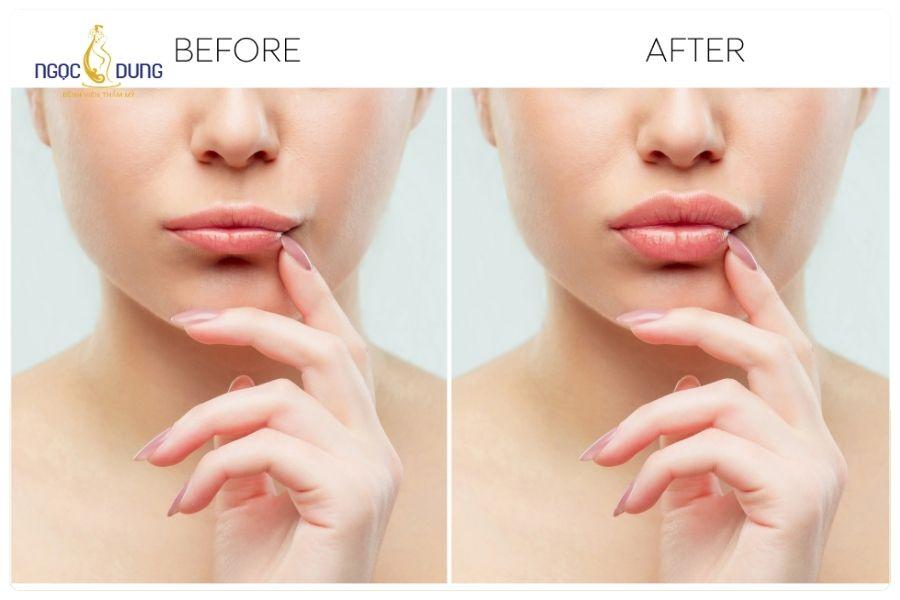 Tiêm filler giá bao nhiêu? Bảng giá cập nhật mới nhất 25 Chăm sóc đúng cách sau tiêm filler giúp kết quả ổn định và tự nhiên hơn