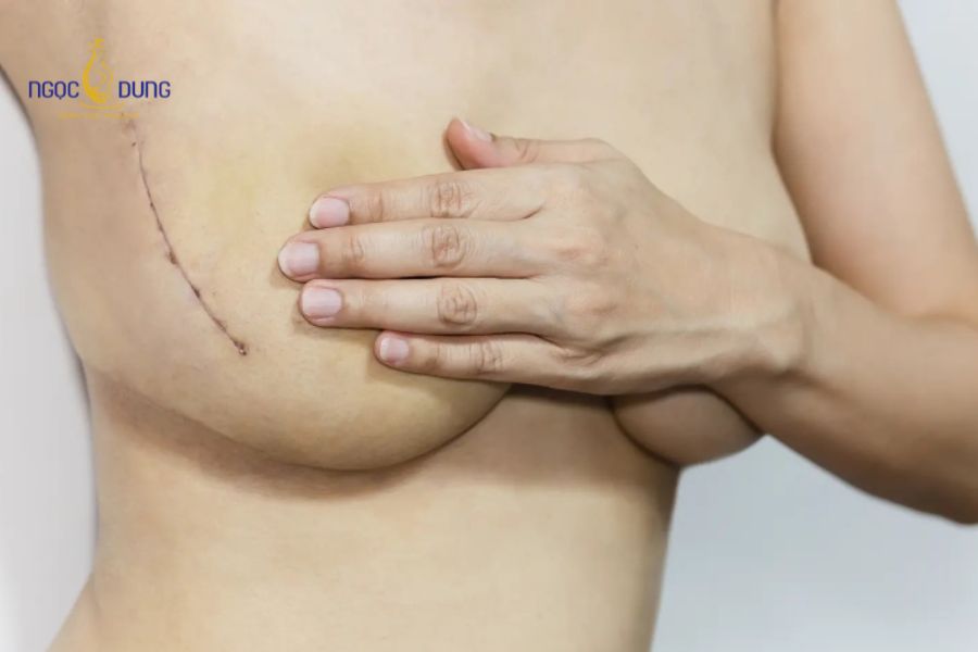 Sẹo nâng ngực: Nguyên nhân, phân loại và cách giảm thiểu 13 Chế độ kiêng cữ thực phẩm gây sẹo lồi, mưng mủ và tăng sắc tố da sau phẫu thuật
