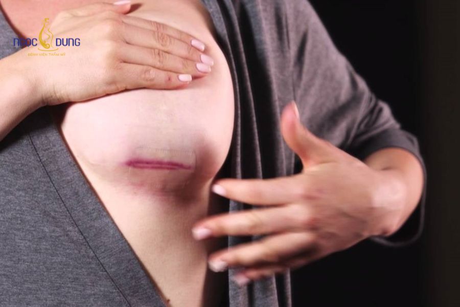Sẹo nâng ngực: Nguyên nhân, phân loại và cách giảm thiểu 11 Cơ địa da và yếu tố di truyền tác động trực tiếp đến tốc độ tái tạo mô sẹo