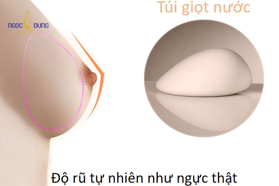 Nâng ngực túi Mentor: Các loại túi, ưu nhược điểm, bảng giá 12 Dáng túi giọt nước Mentor MemoryShape mô phỏng đường cong tự nhiên của tuyến vú