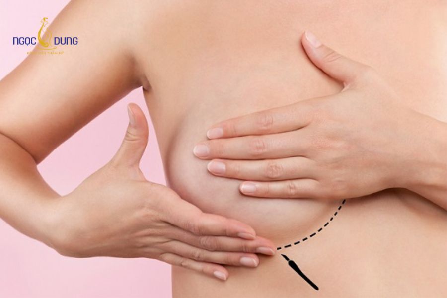 Nâng ngực size bao nhiêu thì đẹp? Chuẩn tỷ lệ vàng vòng 1 12 Độ đàn hồi da và mô tuyến vú giúp che phủ viền túi độn ngực hiệu quả