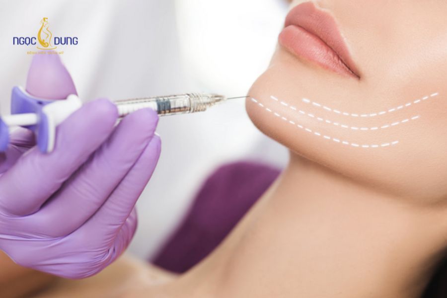 Tiêm filler được bao lâu thì tan hết? Giải đáp chi tiết 12 Filler gốc HA có đặc tính tự phân hủy sinh học an toàn mà không để lại dị vật trong da