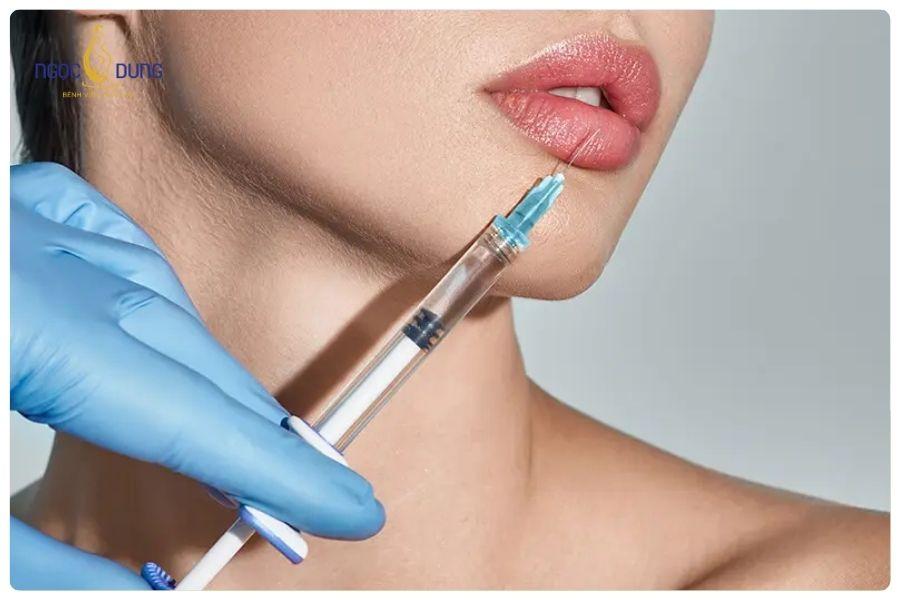 Tiêm filler giá bao nhiêu? Bảng giá cập nhật mới nhất 18 Filler thường được ứng dụng ở nhiều vị trí như môi, cằm, má, mũi và thái dương