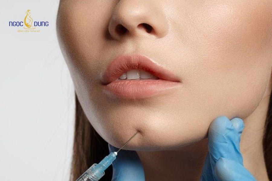Tiêm filler uống bia có sao không? Cần kiêng bao lâu? 13 Giữ cơ mặt thư giãn, tránh cười lớn hay nhăn mặt để filler tích hợp vào mô da một cách tự nhiên