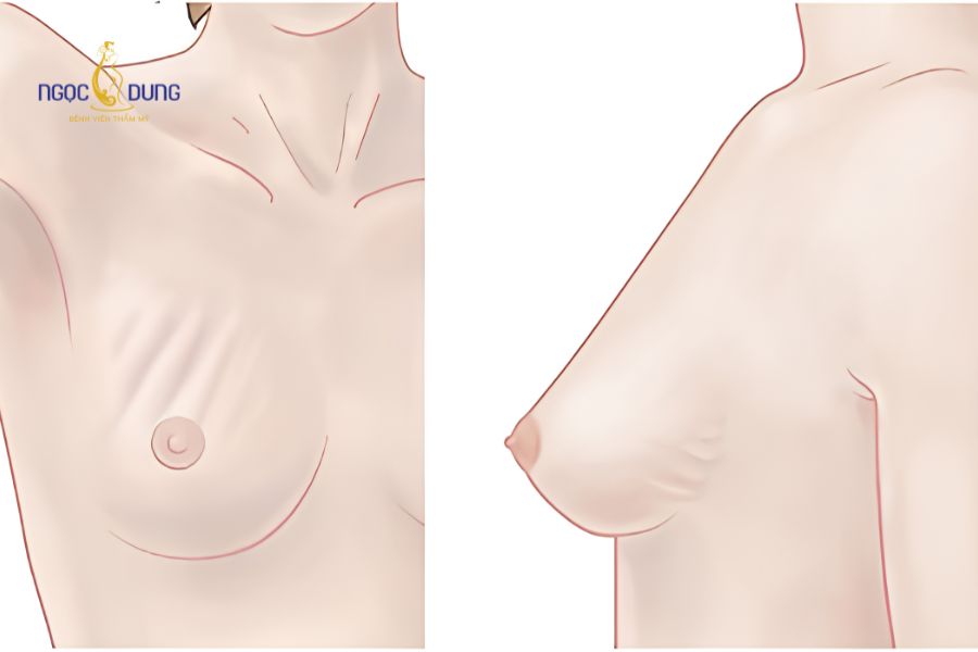 Nâng ngực có nguy hiểm không? Giải đáp và cảnh báo rủi ro 14 Hiện tượng gợn sóng trên bề mặt da ngực và giải pháp khắc phục đặt túi dưới cơ