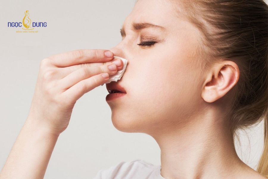 Tiêm filler mũi bị sưng: Bao lâu hết và cách giảm sưng 18 Hiện tượng sưng muộn thường bắt nguồn từ chất làm đầy kém chất lượng hoặc phản ứng miễn dịch chậm