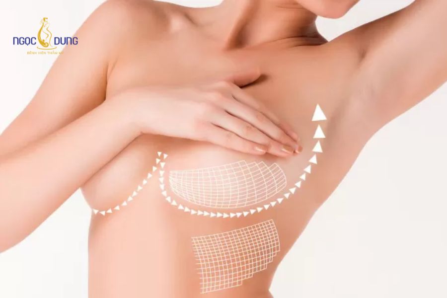 Nâng ngực không phẫu thuật là gì? Phương pháp và đánh giá 12 Hiệu quả cải thiện dáng ngực phụ thuộc lớn vào cơ địa và tỷ lệ mô tuyến vú ban đầu